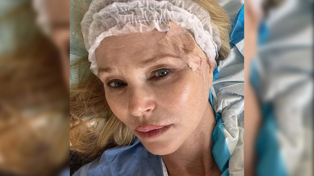 Foto di Christie Brinkley dell'intervento chirurgico per il cancro della pelle